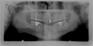 How Often Should You get Dental X-rays?