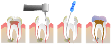 Root Canal Illustration Molar