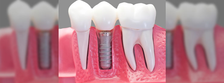 Caring for Dental Implants