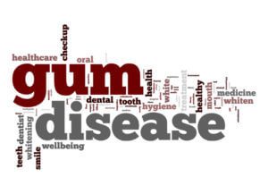 Gum Disease Is Widespread