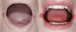 Mouth Redness