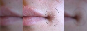 Angular Cheilitis