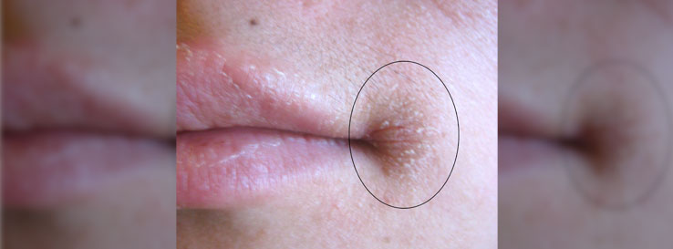 Angular Cheilitis