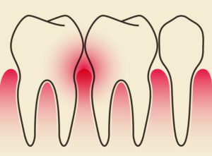 Periodontal Disease